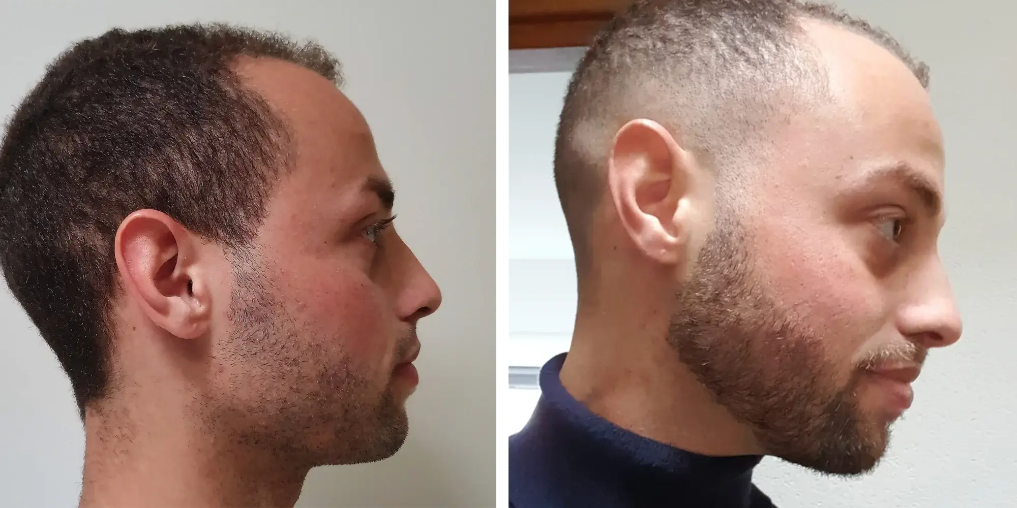 Beard Treatment
